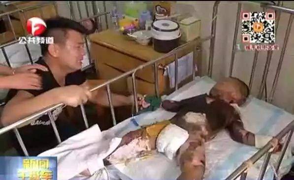 男童跌入開水盆奶奶摸堿急救造成二次傷害 少兒