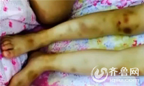 3歲女童全身傷痕累累 家人懷疑系保姆虐待 武漢